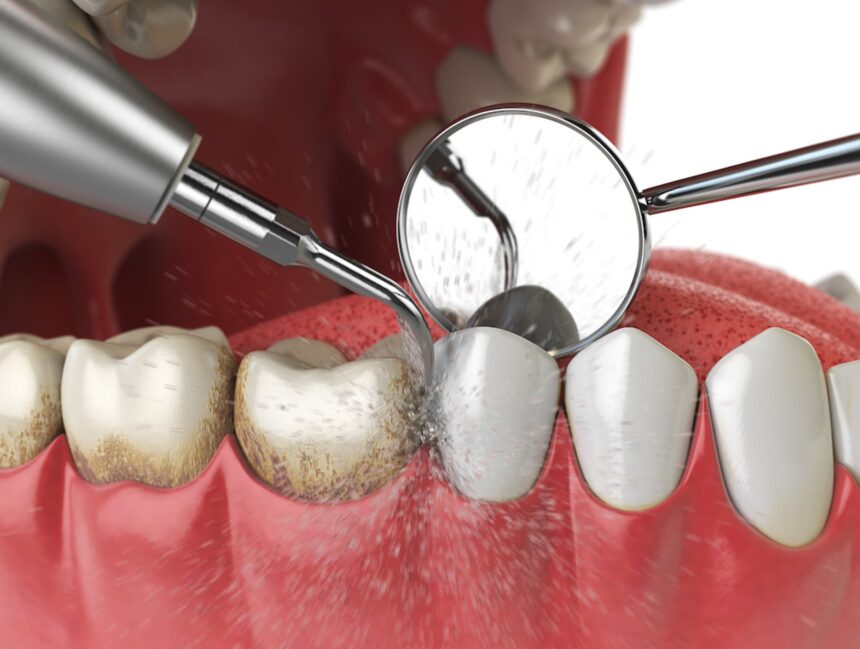 Expert Scaling and Cleaning: The Features of Our Teeth Scaling Services