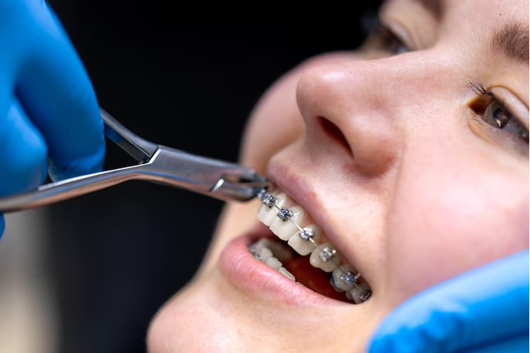 Adult Orthodontics in Abu Dhabi: It’s Never Too Late for a Perfect Smile