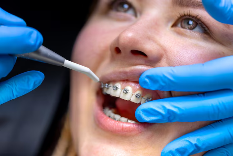 Emergency! My Dental Crown Fell Out: Immediate Steps to Take and What Not to Do.